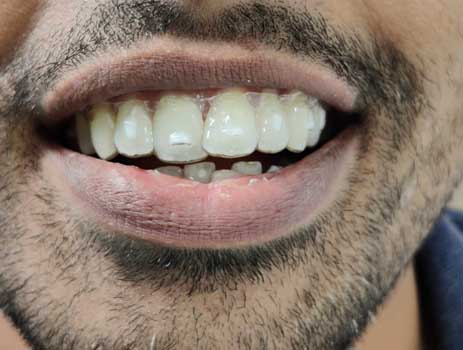 Invisible Braces in Hyderabad