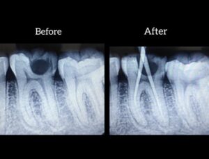 Root Canal Treatment in Hyderabad