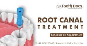Root Canal Treatment in Hyderabad