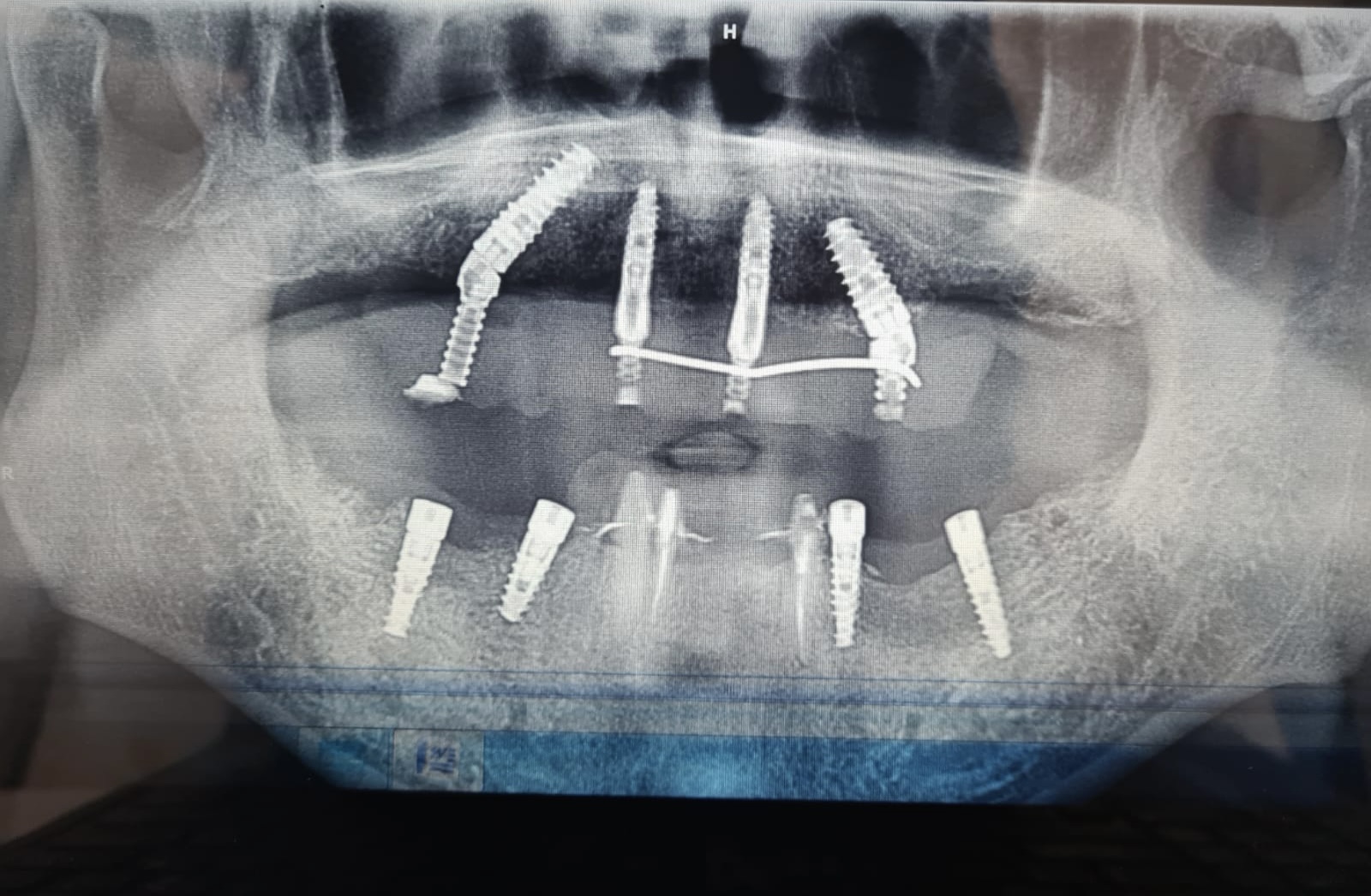 AllOn4 Full Mouth Dental Implants Tooth Docs Hyd
