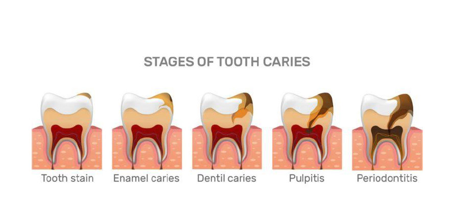 Stages of root canal treatment
