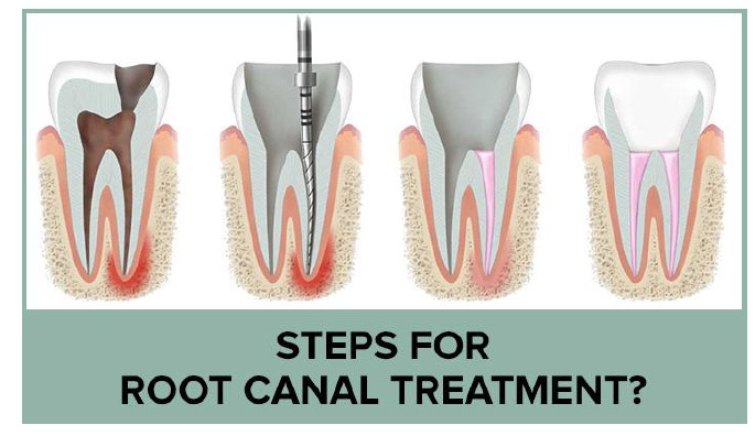 Steps for Root Canal Treatment